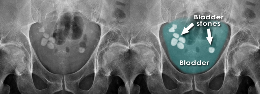 سنگ مثانه 28 میلیمتری - درمان سنگ مثانه 28 میلیمتری - دفع  سنگ مثانه 28 میلیمتری بدون جراحی - درمان سنگ مثانه 28 میلیمتری بدون جراحی - سنگ شکن سنگ مثانه 28 میلیمتری بدون جراحی