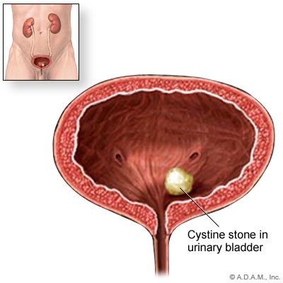 سنگ مثانه 12 میلی متری - درمان سنگ مثانه 12 میلی متری - سنگ شکن سنگ مثانه 12 میلی متری - دفع فوری سنگ مثانه 12 میلی متری - سنگ مثانه 12 میلیمتری - سنگ شکن سنگ مثانه 12 میلیمتری - درمان سنگ مثانه 12 میلی متری بدون جراحی