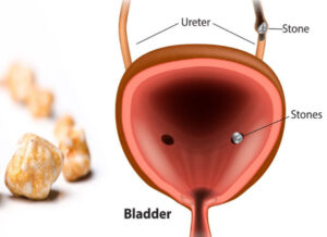 سنگ مثانه 40 میلیمتری - سنگ مثانه 40 میلی متری - درمان سنگ مثانه 40 میلیمتری - درمان سنگ مثانه 40 میلی متری - سنگ شکن سنگ مثانه 40 میلیمتری - سنگ شکن سنگ مثانه 40 میلی متری - دفع فوری سنگ مثانه بزرگ